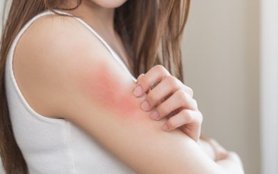 Kako prepoznati alergijsku reakciju na kozmetiku